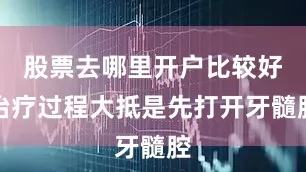 股票去哪里开户比较好治疗过程大抵是先打开牙髓腔